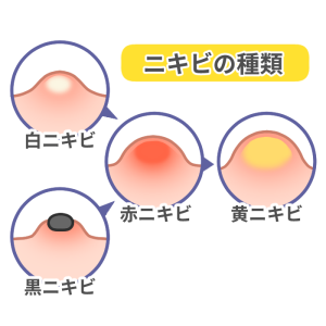 ニキビの説明画像